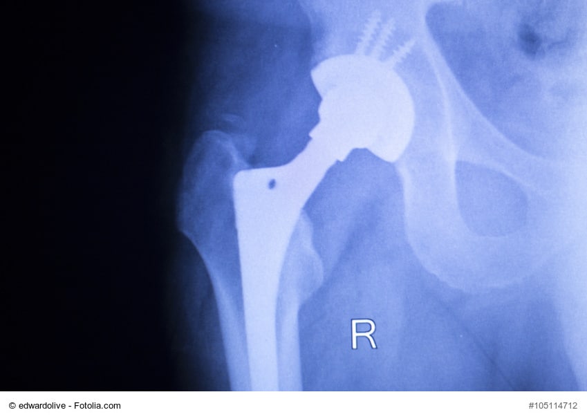 X-ray of metal hip replacement