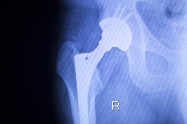 Hip-replacement-2.jpg