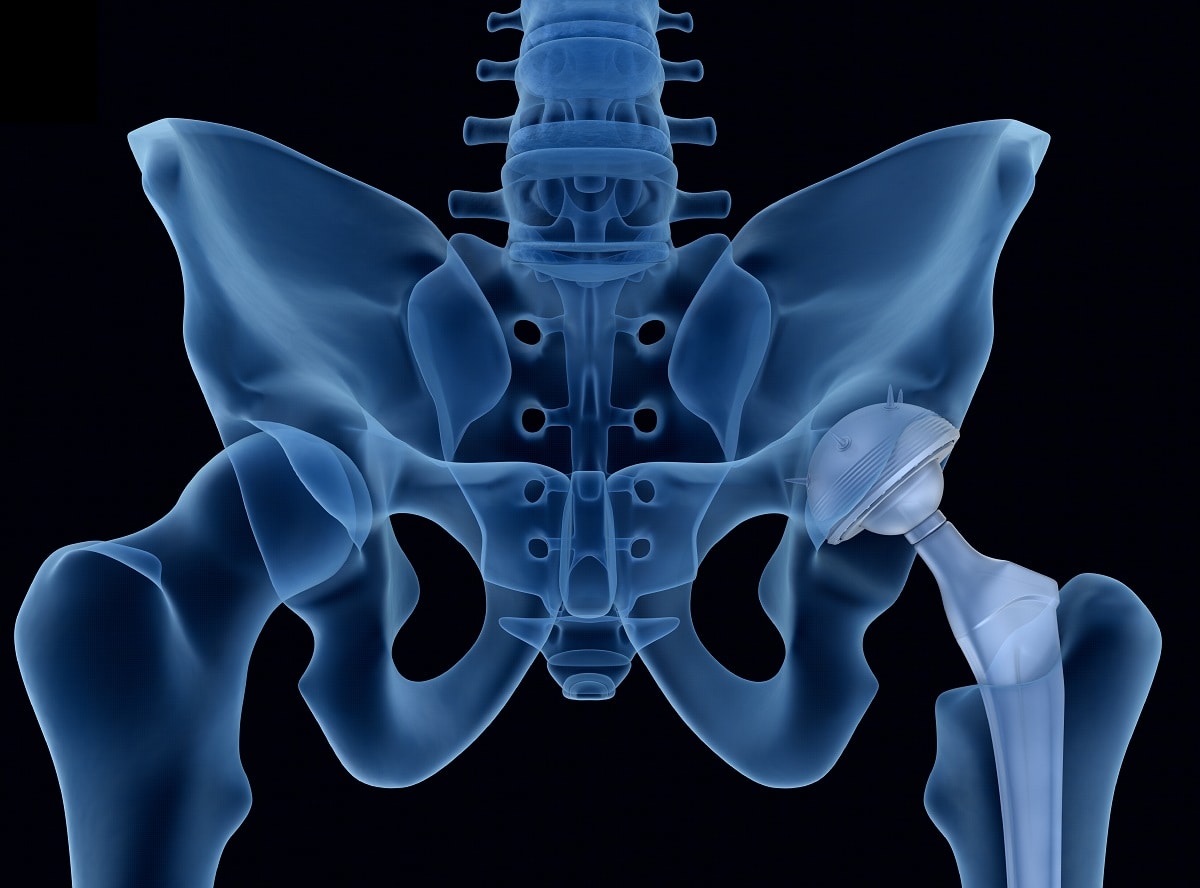 Hip-replacement-3.jpg