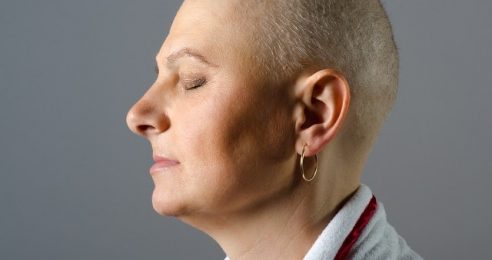 Portrait of bald woman cancer patient after successful chemotherapy.